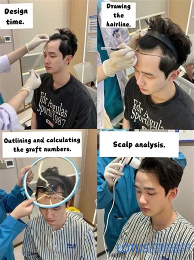 POV: Men’s No-Shave Hairline Transplant — Before & After Transformation