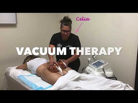 Vacuum Therapy For The Perfect BBL | Cupping