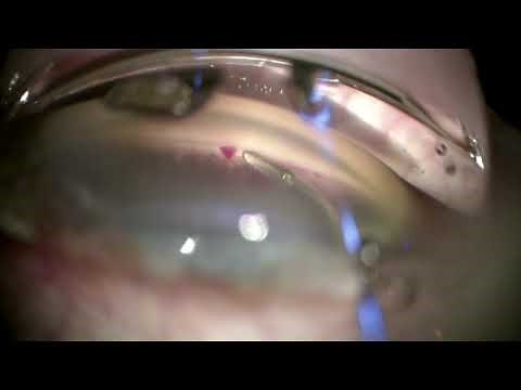 OMNI Viscodilation, Hydrus, and Cataract surgery - I Paul Singh, MD