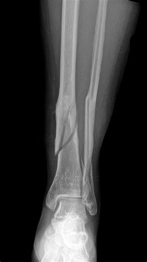 From fracture to recovery. Tibia & fibula injury treated with precise surgery and proper rehab, restoring stability and movement. #TibiaFibula #OrthopedicSurgery #BeforeAfter #TraumaCare