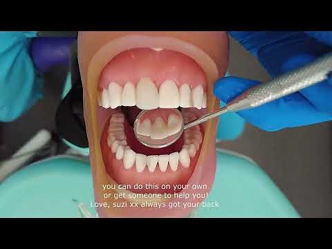How to fix your chipped tooth at home beautifully