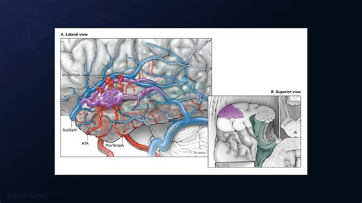 #458: Microsurgical Resection of a Lateral Temporal Arteriovenous Malformation: Skeletonization Technique for En Passage Arteries