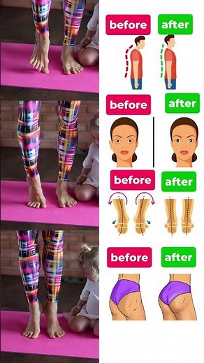 💥 Take the First Step! Correct Valgus + Relieve Foot Pain 📥 SAVE THIS WORKOUT #shorts