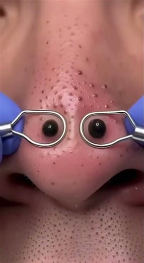Blackhead Extraction Protocol Activated 🤖🧴