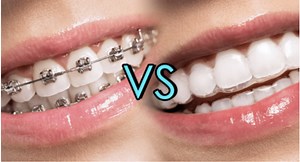 Orthodontiste Luxembourg | Le prix de l'orthodontie invisible adultes et enfants