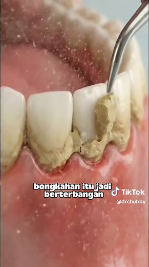 Pembersihan Karang Gigi dengan Alat Berbeda