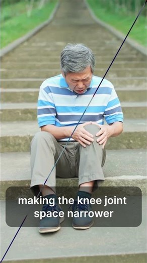 Knee Osteoarthritis: 2 Simple Exercises to Avoid Surgery