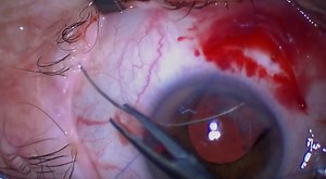 Scleral Fixation of In-Bag Toric IOL - Eyetube