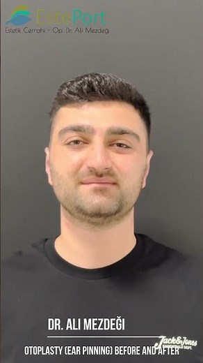 Otoplasty (Ear Pinning) Before and After: Dr. Ali Mezdegi