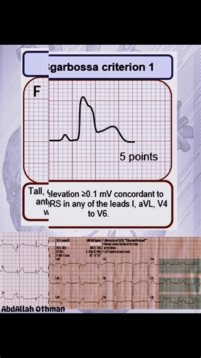 STEMI equivalents. #ecg #ekg #ecginterpretation #cardiology #MedicalEducation #hearthealth | Abdallah Othman