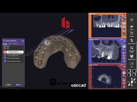 Master EXOPLAN | Tooth-Supported Guide