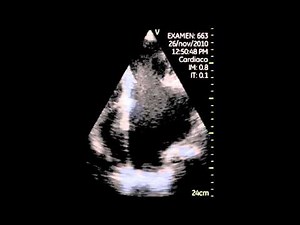 Spontaneous Echo Contrast • Video • MEDtube.net