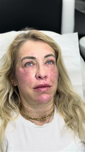 Liquid Facelift #liquidfacelift #botox #filler