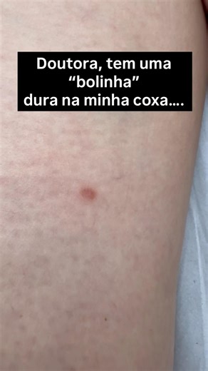 “Bolinha” dura na coxa. Conheça o dermatofibroma. #dermatofibroma #dermatoscopia #dermoscopy