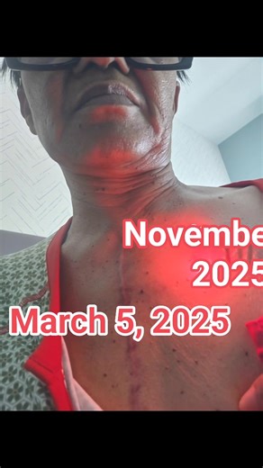 On March 5th, I underwent open heart surgery. Then, on Thursday, November 25th, I had a pacemaker implanted. Following the recovery from the pacemaker procedure around January or February, I will undergo thyroid surgery for the removal of my left thyroid, which has been diagnosed with cancer. I am praying that the cancer has not spread to the right. Since March I been going through. The journey has been hard mentally and physically sometime crying in silence. One thing I know God been good to me