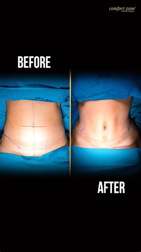 Luxury Brand by Comfort Zone in Istanbul, Turkey 🇹🇷 | What is a tummy tuck operation? — medically called an abdominoplasty — is a cosmetic surgical procedure designed to flatten and tighten the... | Instagram