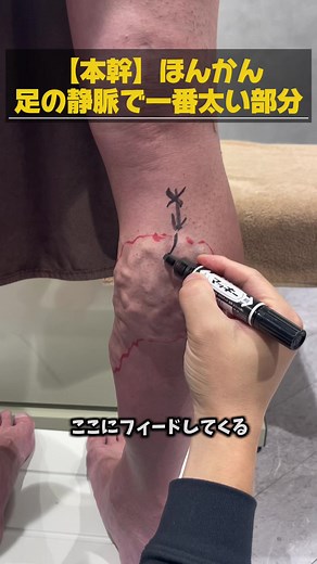 下肢静脈瘤治療術前解説とマーキング