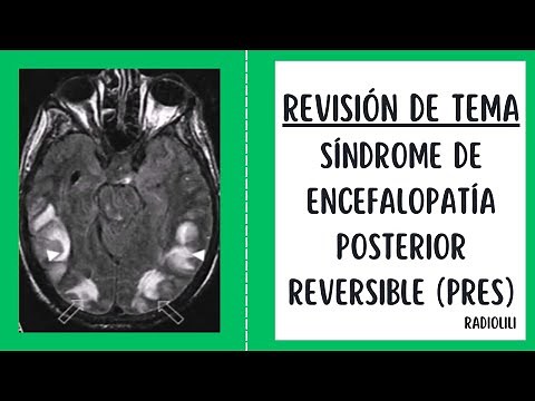 Síndrome de Encefalopatía Posterior Reversible (PRES).