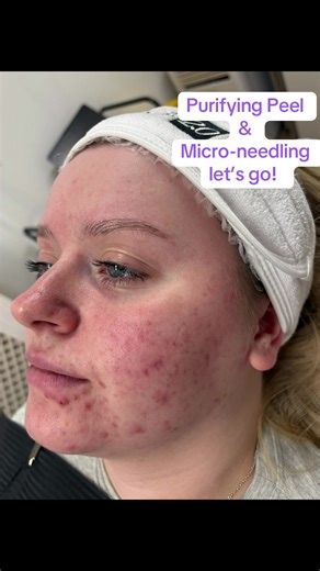 Impure skin needs more than a surface solution. Our powerhouse treatment combining Derma 2.0 Purifying Peel with Microneedling works where congestion and breakouts actually begin below the surface. This treatment is ideal for skin that feels blocked, inflamed, dull, or prone to breakouts. ✨ Why your skin needs it • Deeply purifies pores and removes built up debris • Regulates excess oil without stripping the skin • Reduces congestion and breakout activity • Calms inflammation and redness • Impro