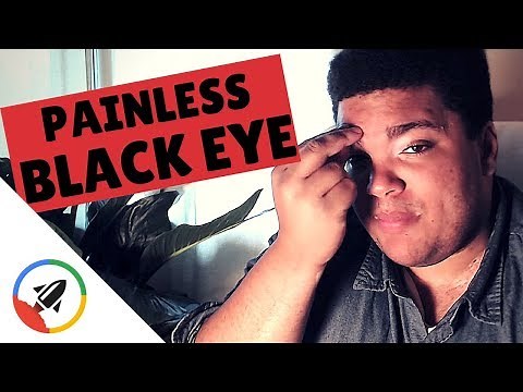 How To Give Yourself A Black Eye | No Pain!