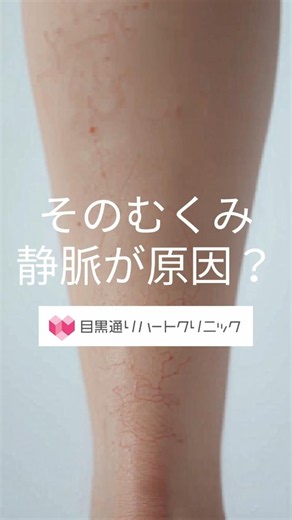 そのむくみ、静脈かも #むくみ #下肢静脈 #血栓 #足のむくみ #循環器内科 #目黒通りハートクリニック