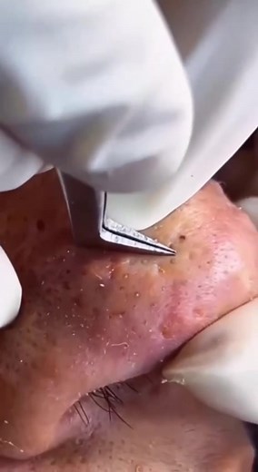 Easy skin cleaning #skinproblem #skincleaning #macrovideo #skincare #blackhead #extractions #pimpleremover #cleaning #pimplepopper #pimpl