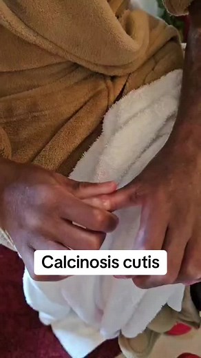 My Reality with Calcinosis Cutis: I’m sharing a glimpse of my journey with calcinosis cutis, a rare disorder causing calcium deposits in the skin and subcutaneous tissue. It’s a condition that’s often symptomless but can sometimes be painful and challenging to manage.As I continue to navigate life with this condition, I’m grateful for your support. You can support my journey by purchasing my books, merchandise, and artworks at www.TheMoExperience.org. Thank you for being a part of my story. 💙 #