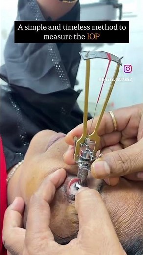 SCHIOTZ TONOMETRY ia a technique used to measure INTRA-OCULAR PRESSURE of and eye.