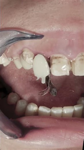 Composite restoration with fiber post to broken anterior tooth #dentist