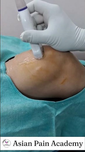 Ultrasound Guided Aspiration of Knee Effusion | Live Pain Intervention by Dr Saurov Gogoi