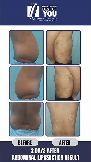 OMG 😳 Amazing Transformation 👍 | 2 Days After Results of Abdominoplasty Surgery | Dr. PK Talwar