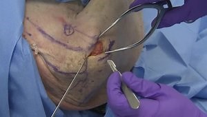 Management of Humeral Shaft Fractures: Intramedullary Nailing, Patient Selection and Outcomes