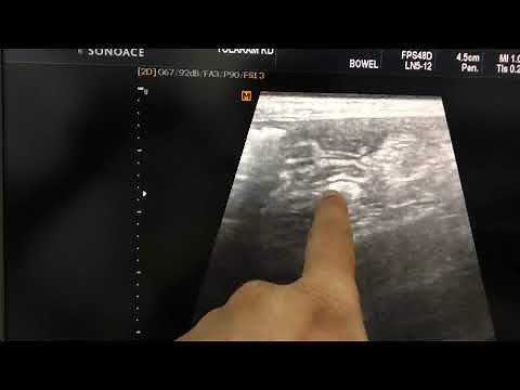 Colitis Ultrasound