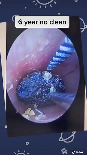 Earwax Removal and Pimple Extraction Procedure