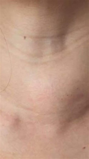 #Goiter is visible swelling or lump on the base of your neck.