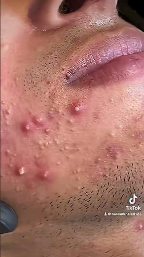 Big black heads #skincare #blackheadsremoval #skincaretips #acnetreatment #deepcleansing