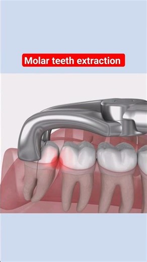 3D animation of molar teeth extraction|wisdom teeth