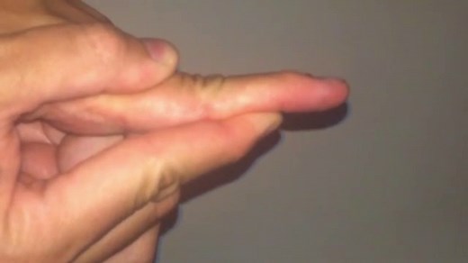 Tendón Extensor: Reparar y Rehabilitar - Dr. Landín - Dr. Thione