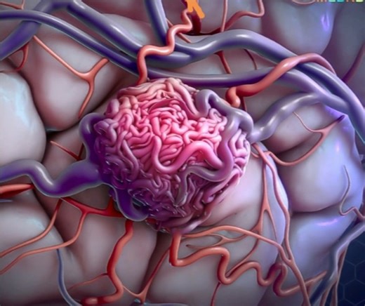 AVM embolisation and resection, intracranial hematoma evacuation