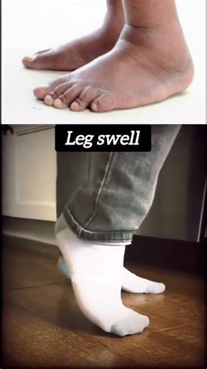 The Best Lymphedema Exercises (Scientific Evidence) 👈 ll #shorts #youtubeshorts #legpain #shortsfeed