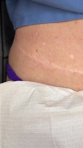 37K views · 40 reactions | Tummy Tuck Scar Camouflage #tummytucksurgery#ttscar#tummytuckrecovery#tummytuckjourney#streatchmarks#inklessstretchmarksremoval#bbl#postsurgeryrecovery#stretchmarks#postpartumbody#cosmeticsurgery | Plasma Lift Skin Tightening Specialist | Facebook