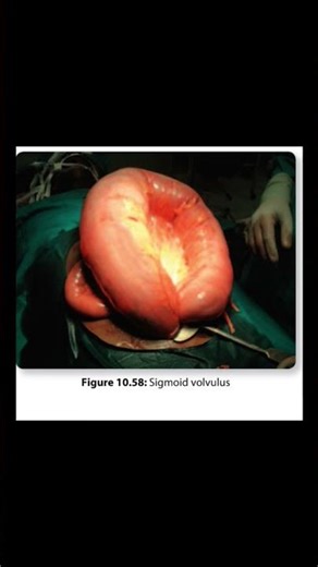 sigmoid volvulus #youtubeshorts #surgeryrecovery #shorts
