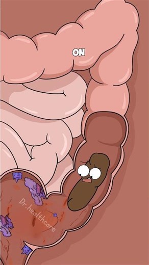 How Doctors Treat Colon Cancer When It Blocks Poop?
