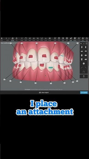 How Invisalign attachments work. An inside look at how we design smiles using Clincheck software.
