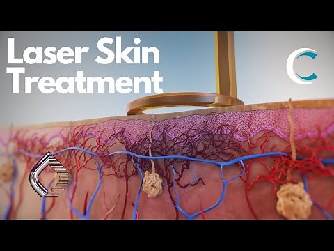 Next Generation Laser Treatment of Skin Lesions and Pigmentation by Candela 3D medical animation)