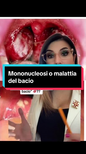 Mononucleosi o malattia del bacio