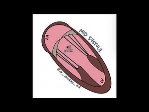 Mitral Valve Prolapse Mid-Systolic Click