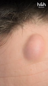 No es solo piel, es cómo te miras al espejo 💔🪞 El bulto de Robert fue apagando su seguridad día a día. ¿Puede la dermatología devolverle confianza? ▶️✨ #ClinidadelaPiel Descubre más contenidos como este en #HBOMax Suscríbete ahora https://bit.ly/MAX-HHLAT | Discovery Home & Health