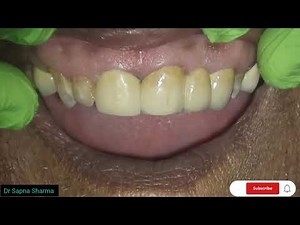 Amazing Front Tooth Transformation | Upper Front Teeth Cap
