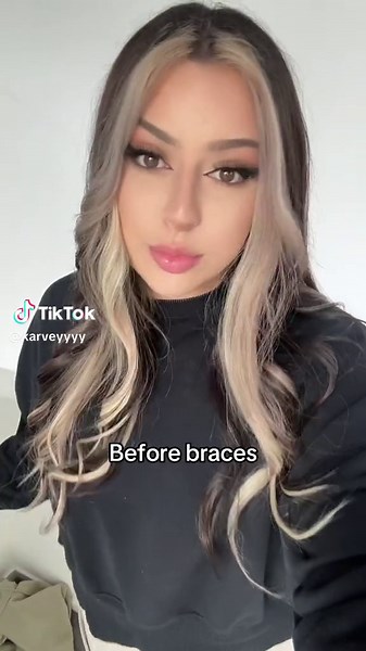 Brace Face Transformation: Before and After Braces